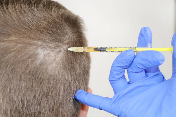 Unlocking the Secrets of PRP Hair Restoration: How It Promotes Hair Growth