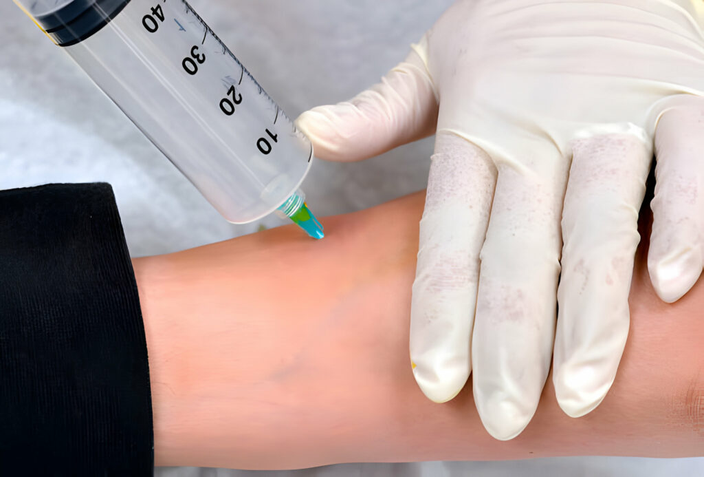 Ozone Injection Therapy